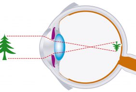 CÁC THẮC MẮC THƯỜNG GẶP VỀ TẬT KHÚC XẠ