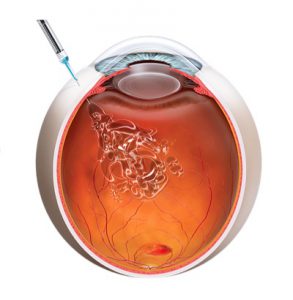 Tiêm chất kháng VEGF vào nội nhãn điều trị AMD thể ướt