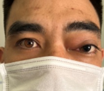 SCHWANNOMA HỐC MẮT