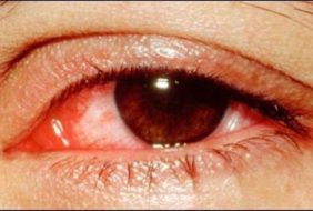 BỆNH VIỆN MẮT – NHỮNG CÂU HỎI THƯỜNG GẶP VỀ BỆNH ĐAU MẮT ĐỎ
