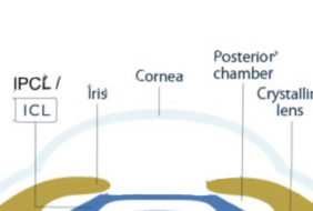 NÊN PHẪU THUẬT LASER HAY PHAKIC IOL?