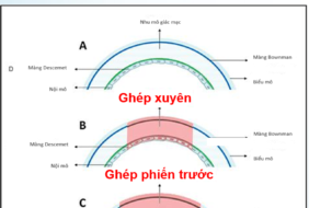 THÔNG TIN TƯ VẤN NB GHÉP GIÁC MẠC