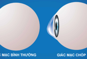 BỆNH GIÁC MẠC CHÓP – KERATOCONUS (KC) – LÀ GÌ?