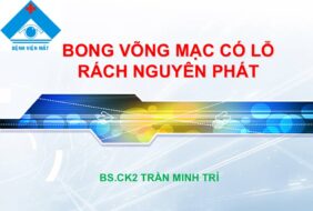Sinh hoạt chuyên môn điều dưỡng: Bong võng mạc có lỗ rách nguyên phát